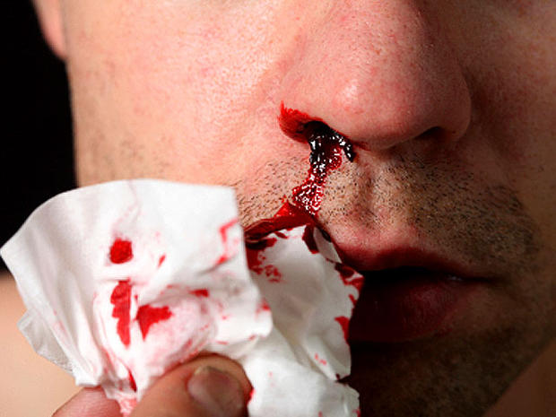 bloody_nose.jpg